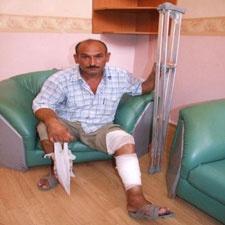 Tarsus'ta Bir Kişinin Ayağındaki alçı bacağını yaktı